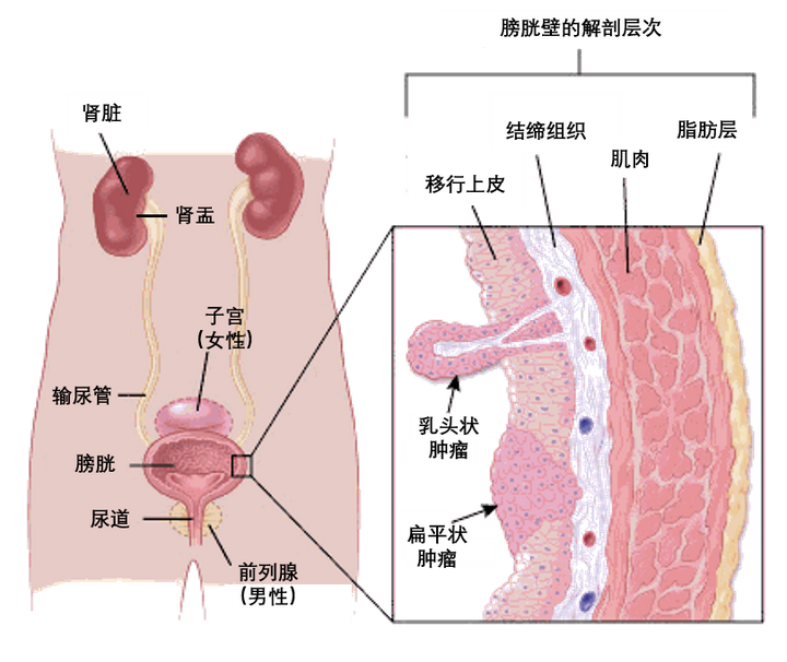 一文读懂膀胱癌的分类 患病风险 筛查和预防 知乎