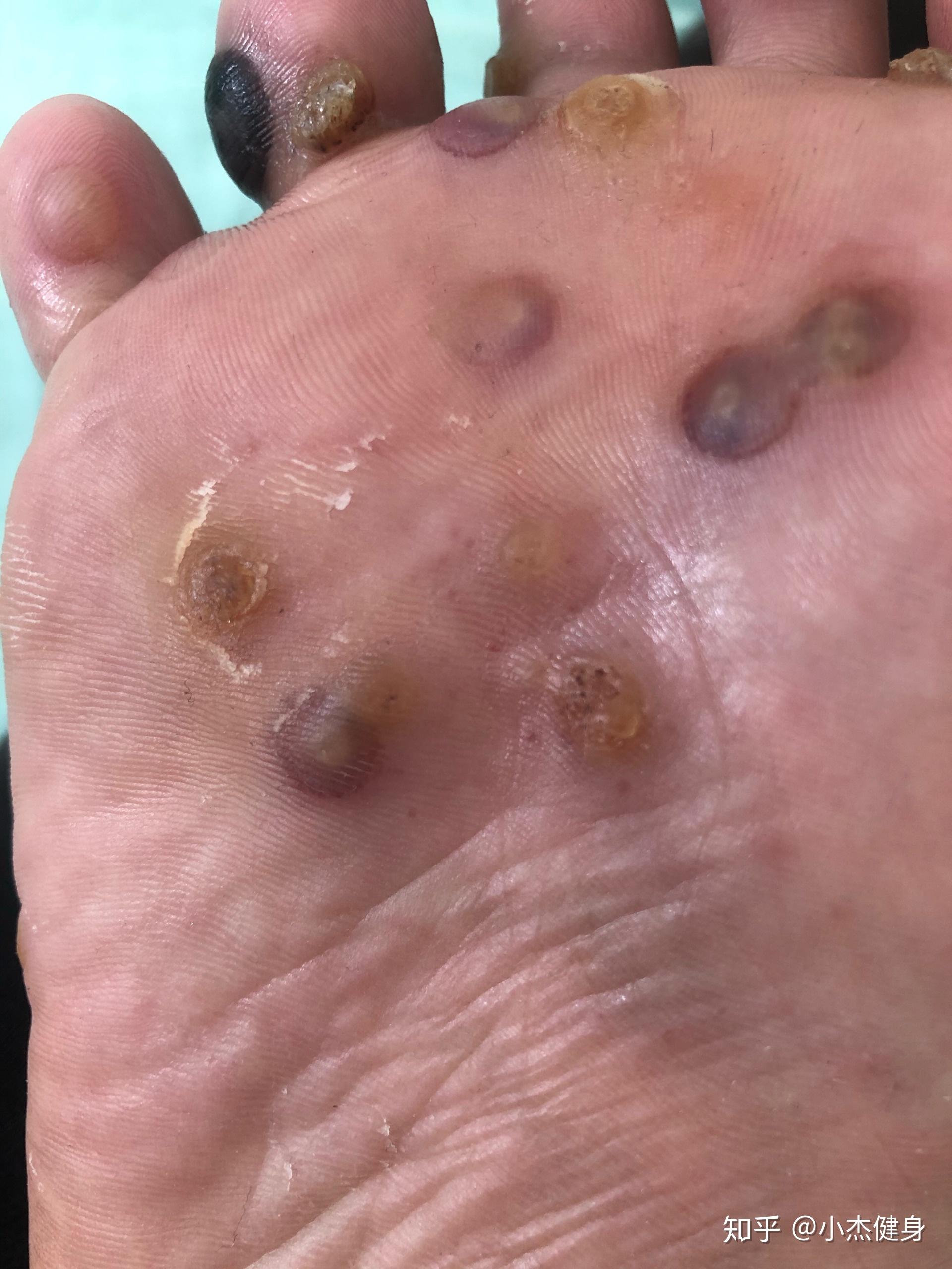 跖疣病魔根除的漫长过程,抵抗!