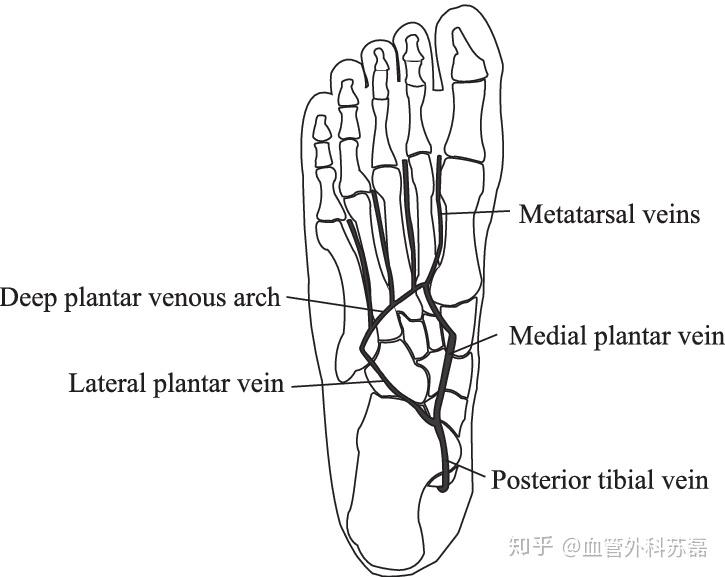足底静脉血栓形成