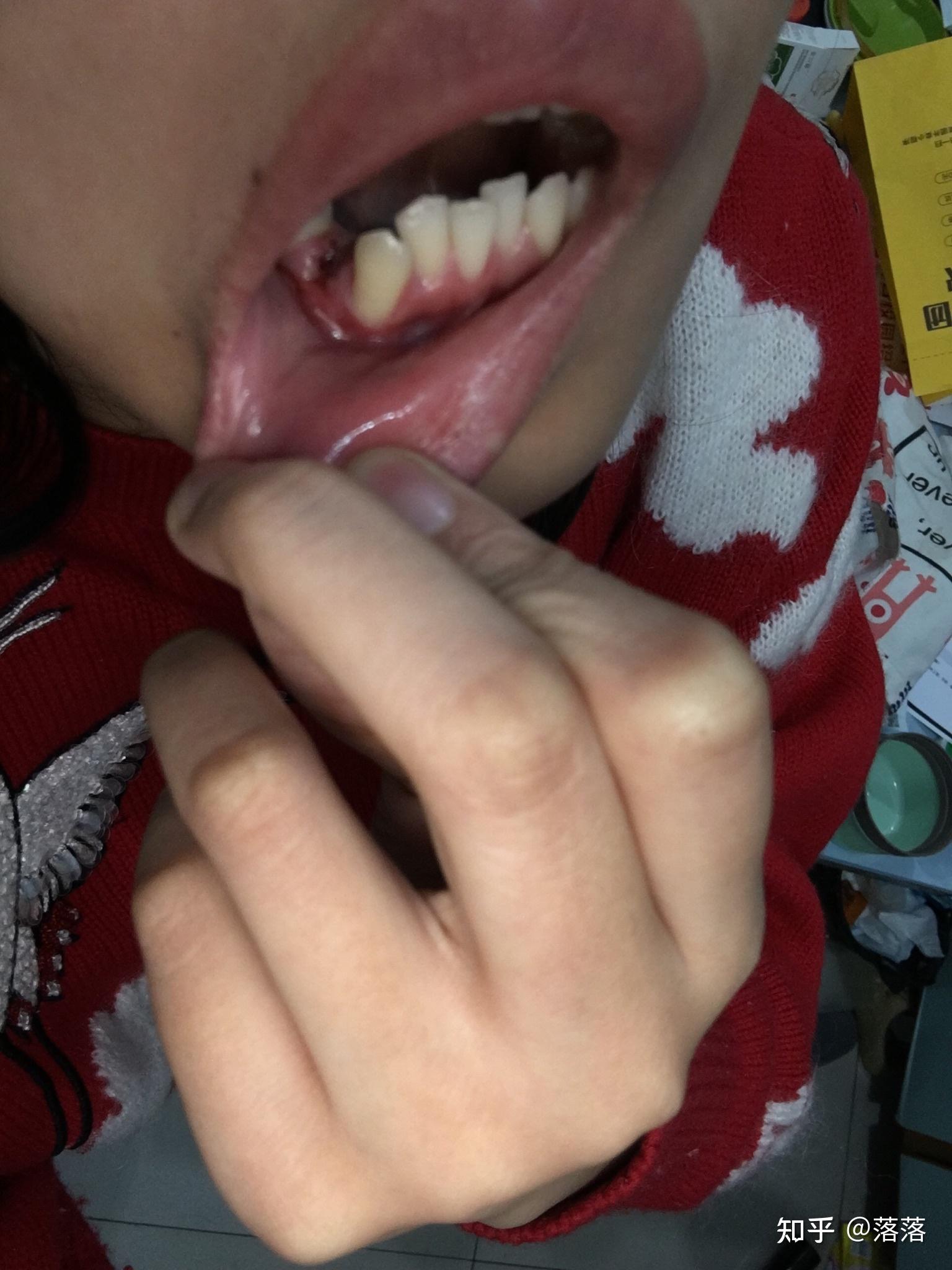 都开始发白,不知道是不是肉膜包被,小部分还是黑红一点,下牙牙龈肿了