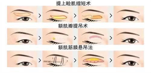 一双眼拯救一张脸别闹了你真的适合做双眼皮吗