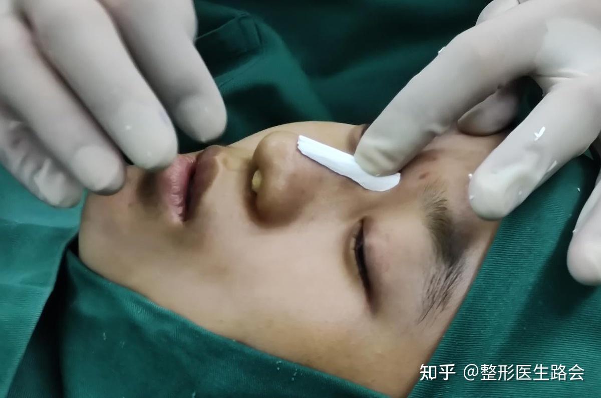5小时20分"全脸整形",20岁小姑娘手术过程「真实细节」分享 - 知乎