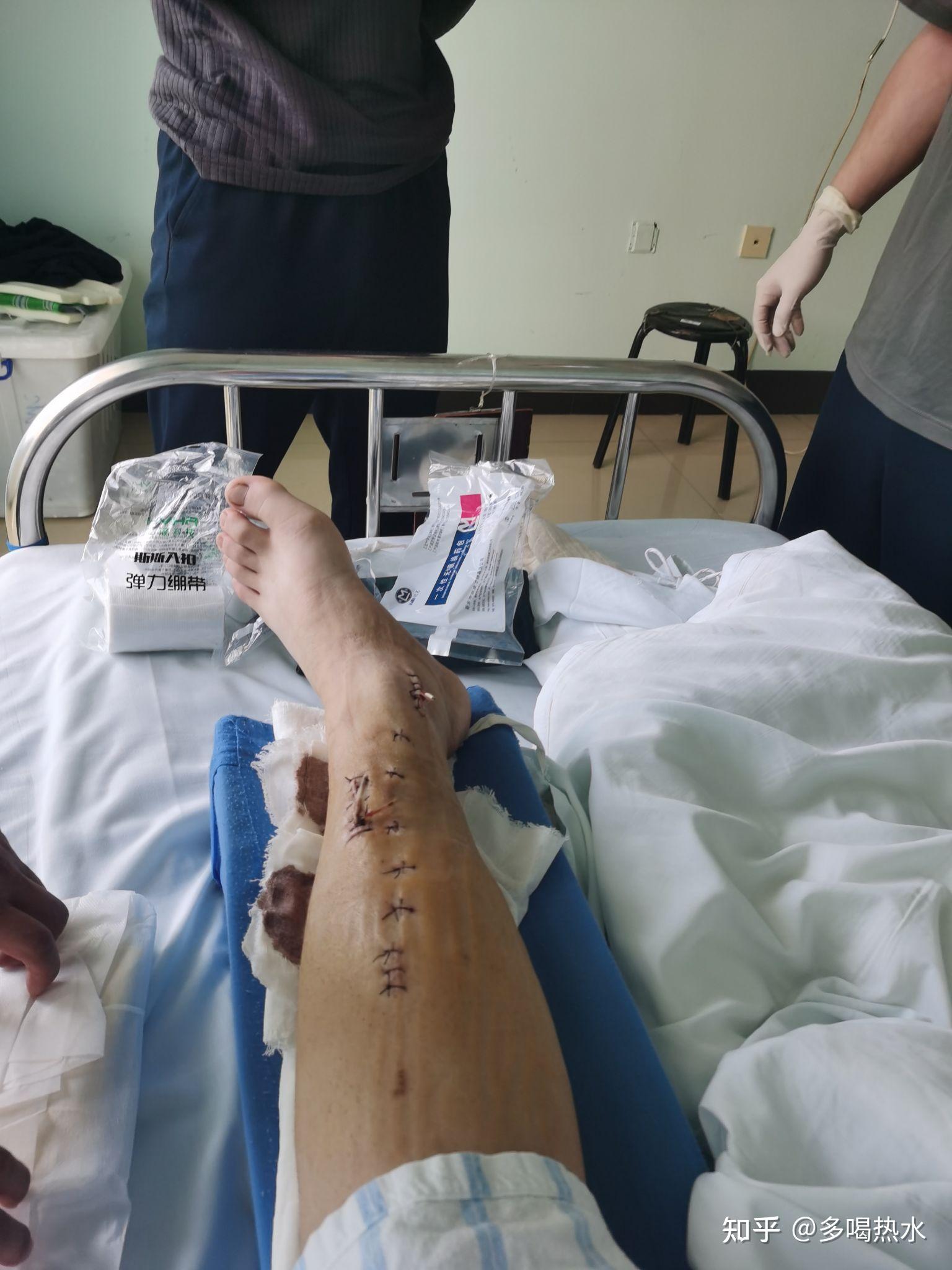 胫腓骨粉碎性骨折恢复全过程