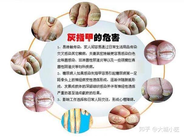 為什麼灰指甲會傳染