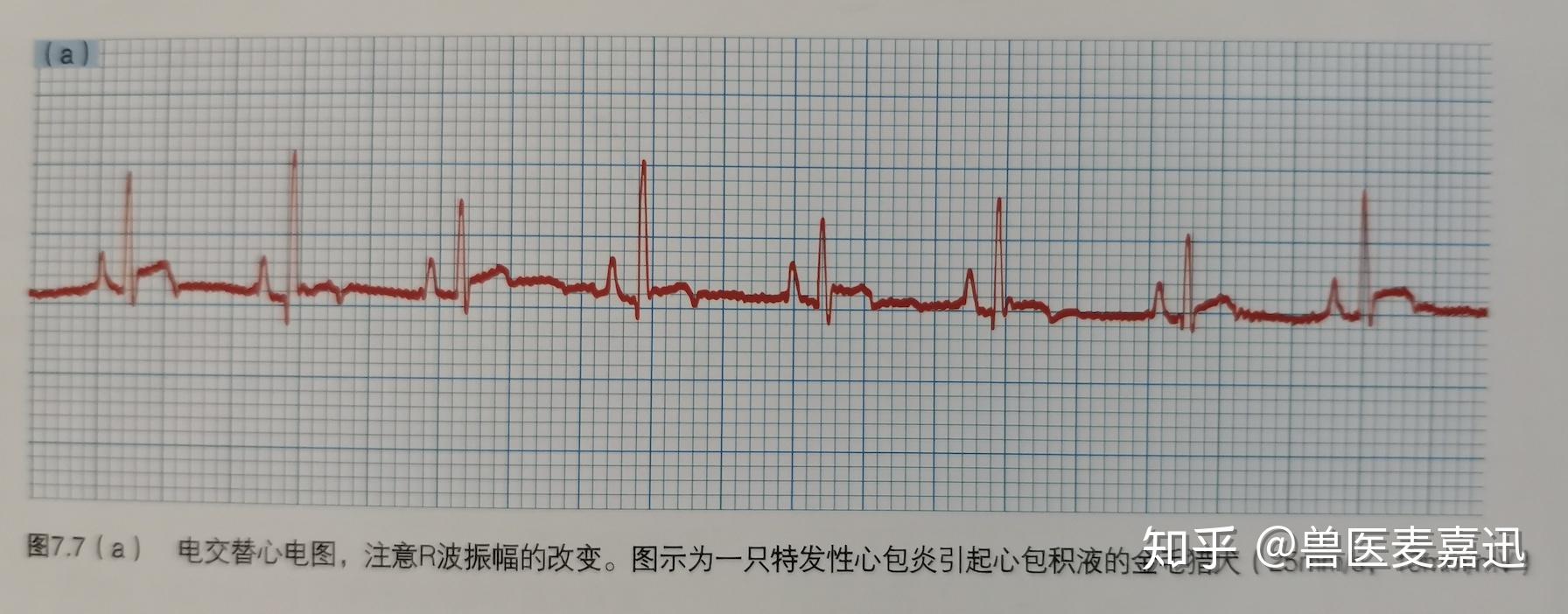 心包积液心电图特征图片