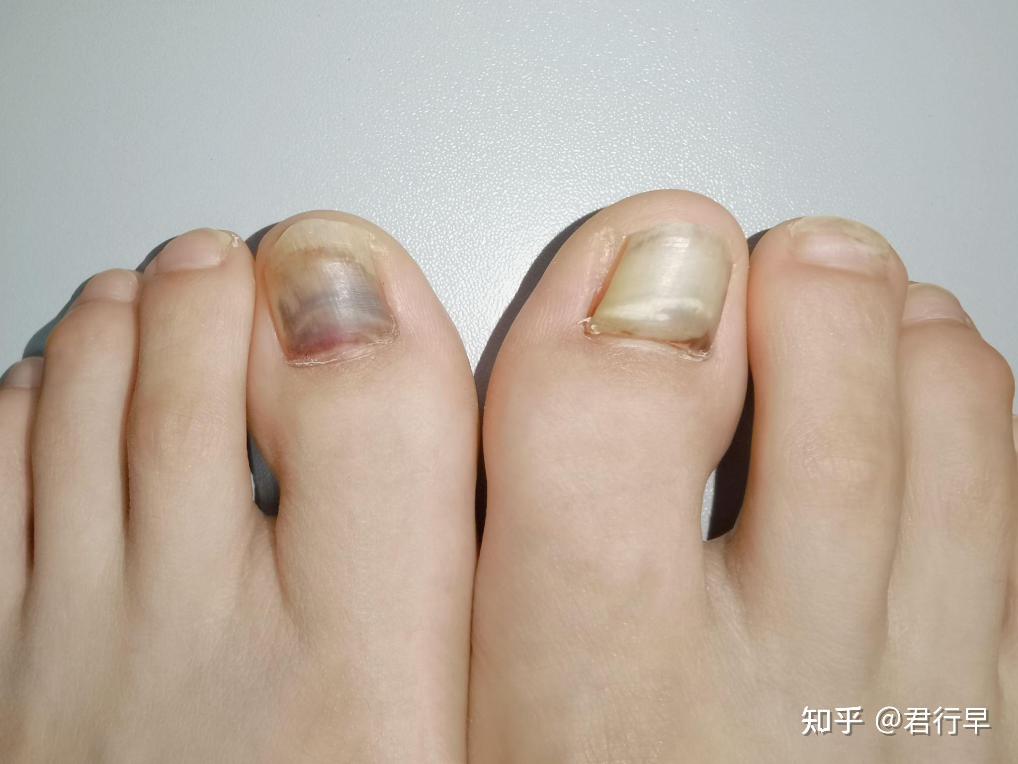 脚趾头恶性肿瘤的图片,脚趾癌 - 伤感说说吧