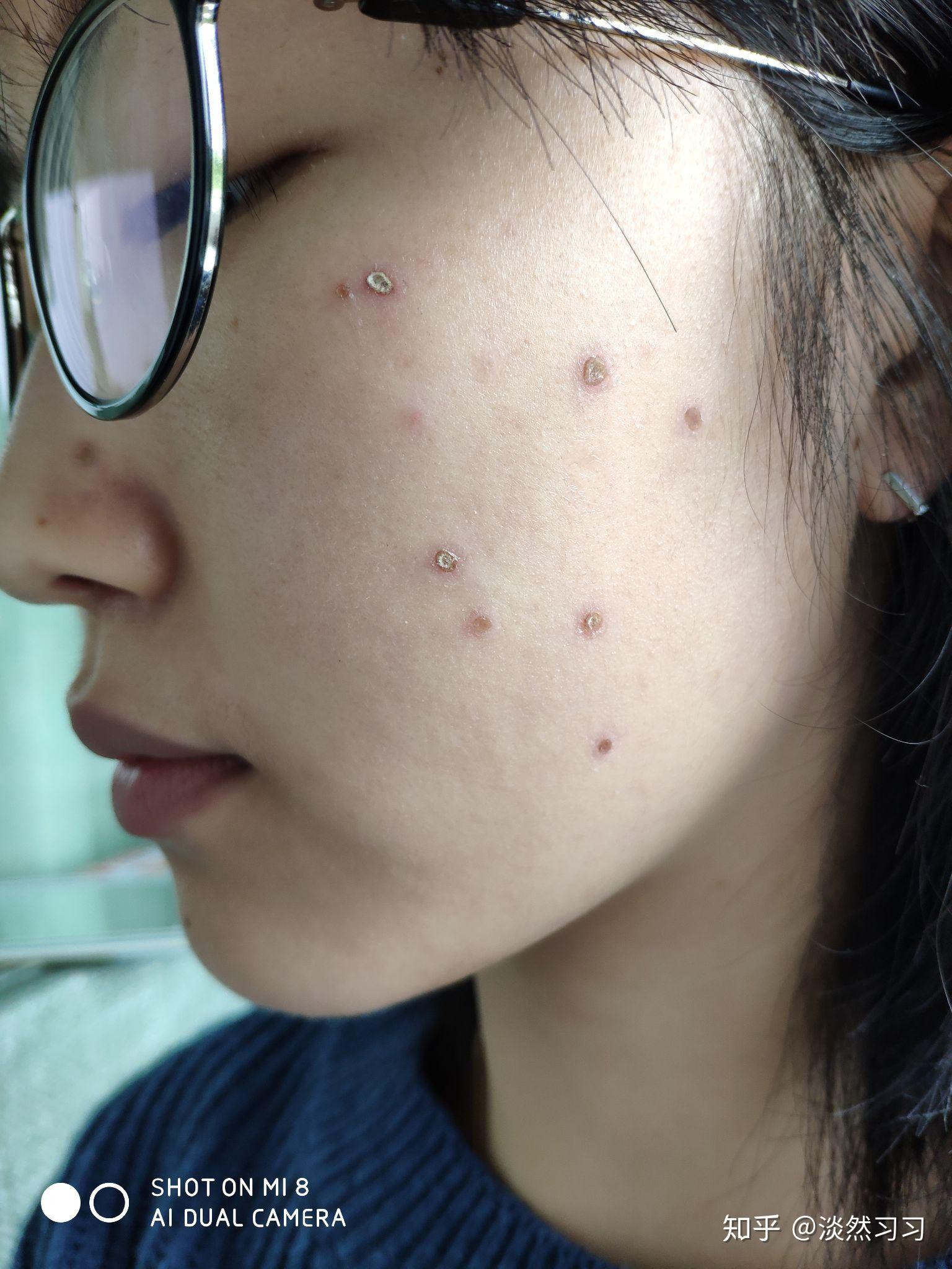 激光点痣分享 - 知乎