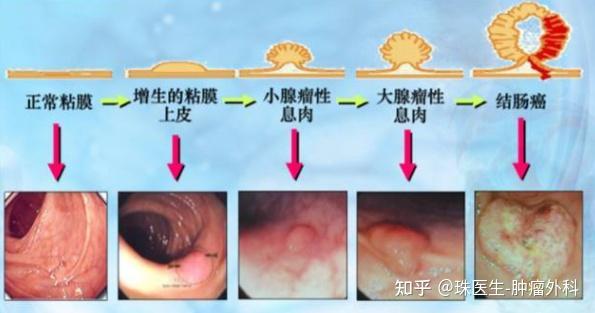 直肠乳头状腺癌图片