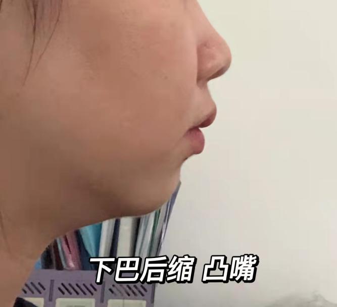 下巴后缩下巴短怎么改善垫下巴玻尿酸还是假体好有哪些后遗症