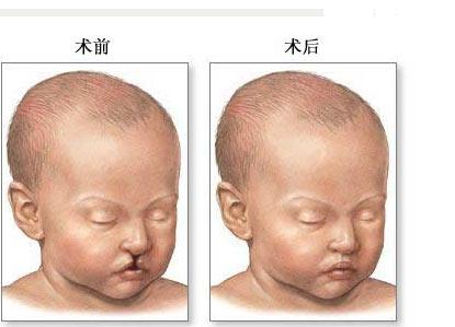 微笑天使-"兔唇"宝宝