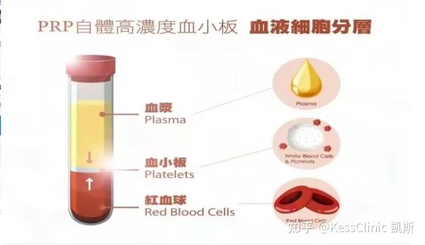 再生治疗的新希望——PRP治疗技术- 知乎