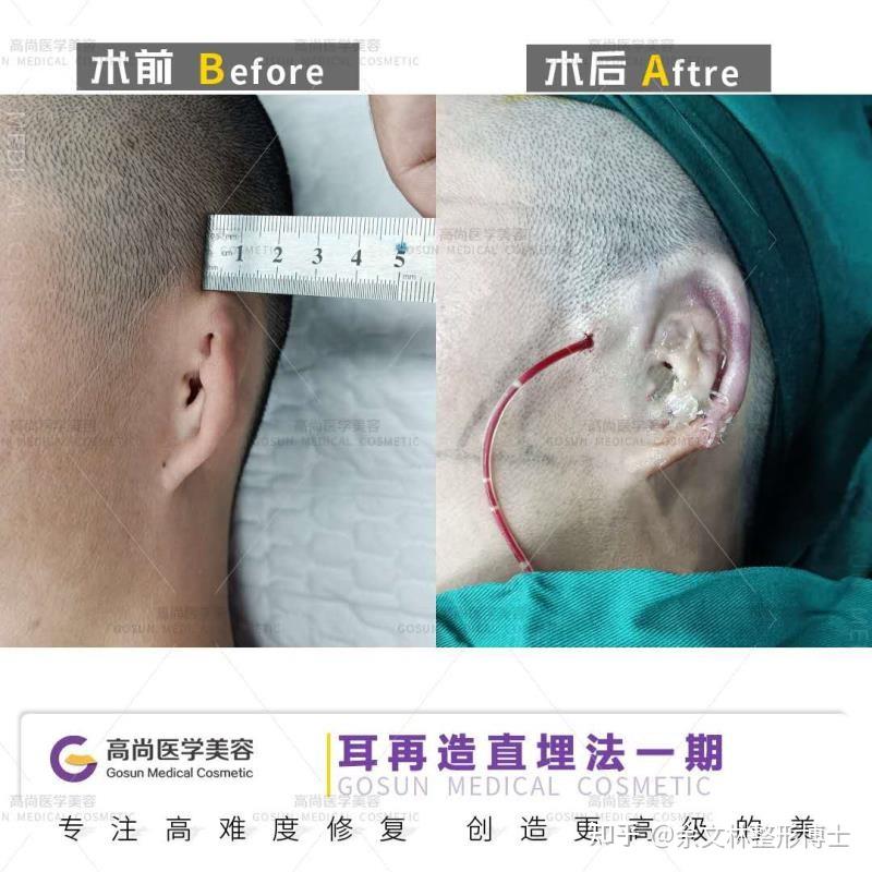 并由耳轮,对耳轮,耳屏,对耳屏,耳垂,耳甲,三角窝,舟状窝等构成,凸凹