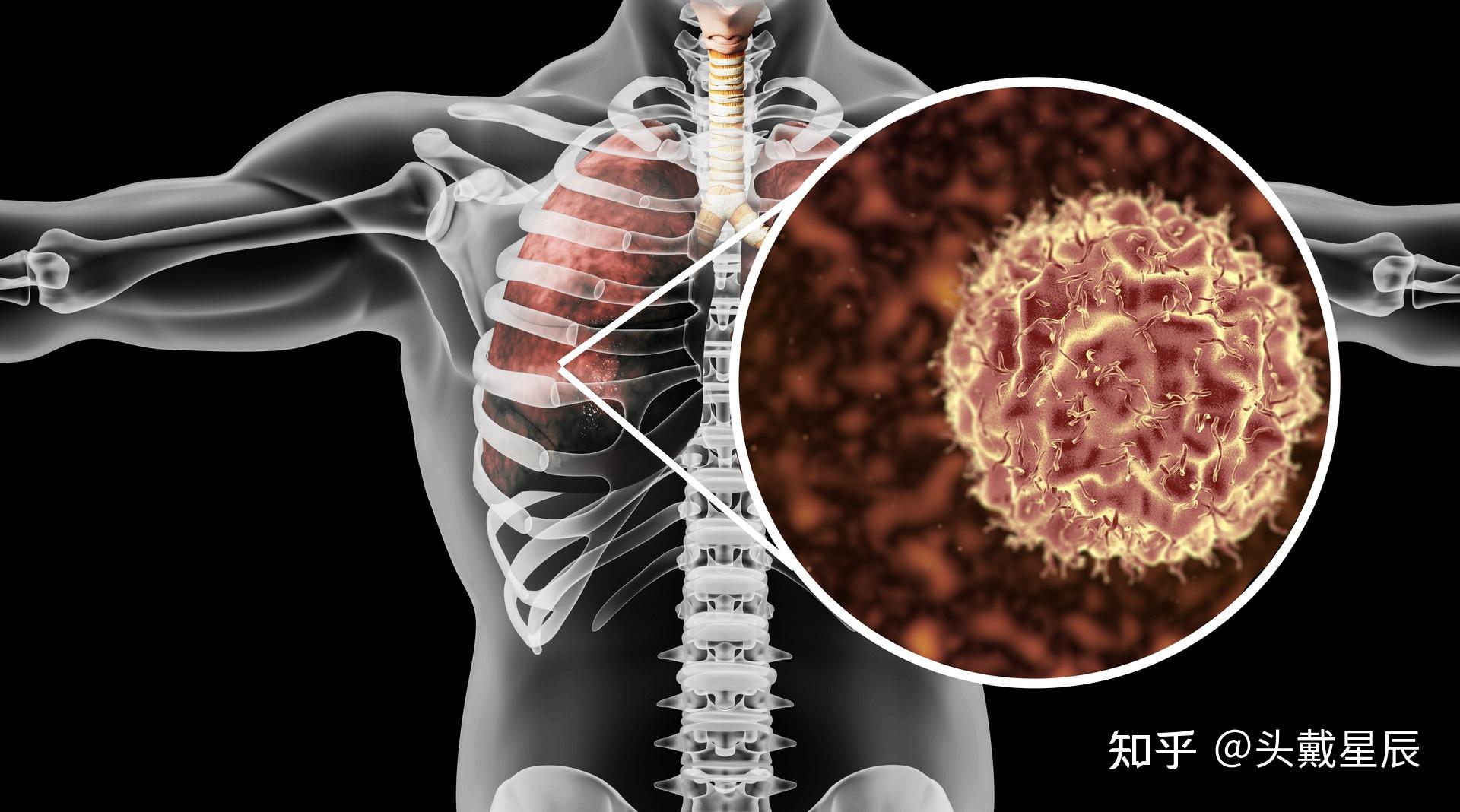 第二节 不同组织类型肺癌的CT表现-呼吸系统-医学