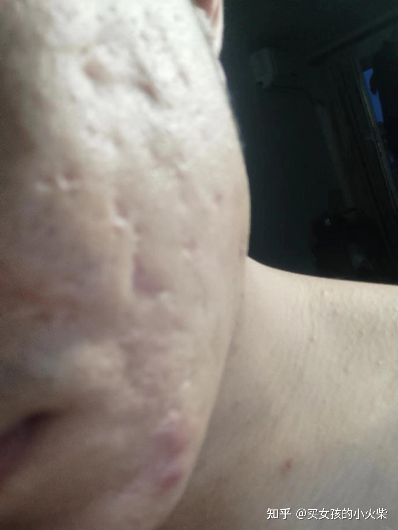 脸上有丘疹和痤疮的发炎皮肤。痤疮造成的疤痕照片摄影图片_ID:309094291-Veer图库