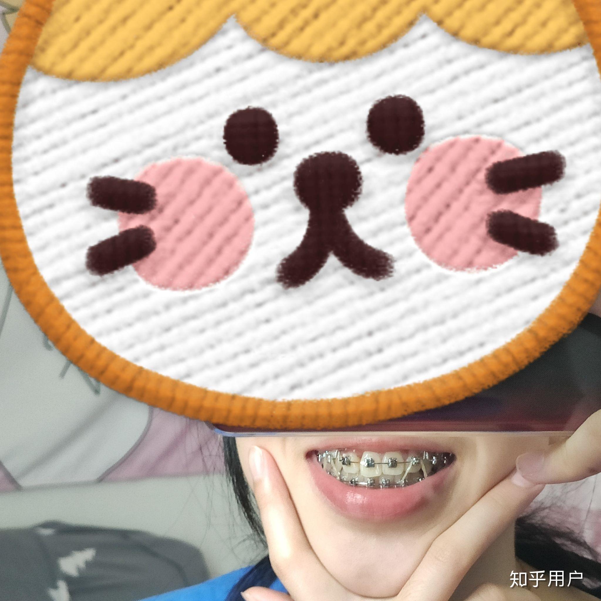 来说说牙齿矫正挂小皮筋是什么感受? - 知乎