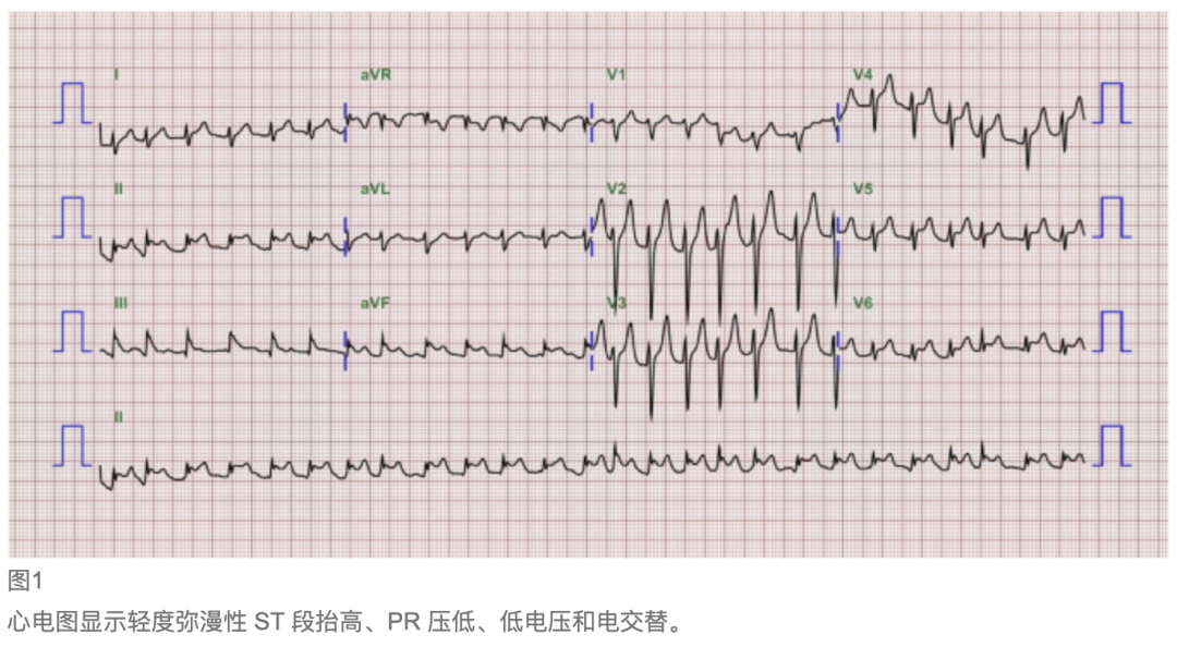 心包积液心电图特征图片