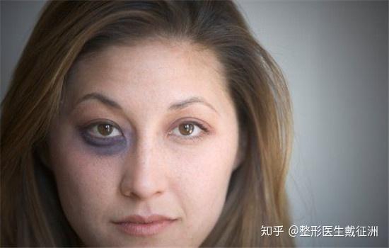 黑眼圈和眼袋的区别你还傻傻分不清吗