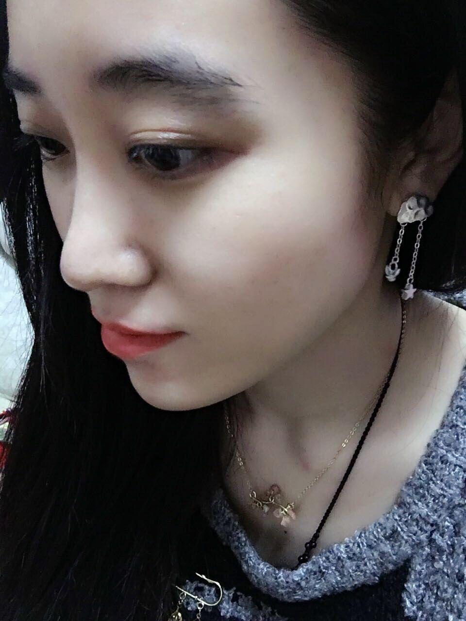 想看线雕隆鼻效果的来呀分享线雕真实感受