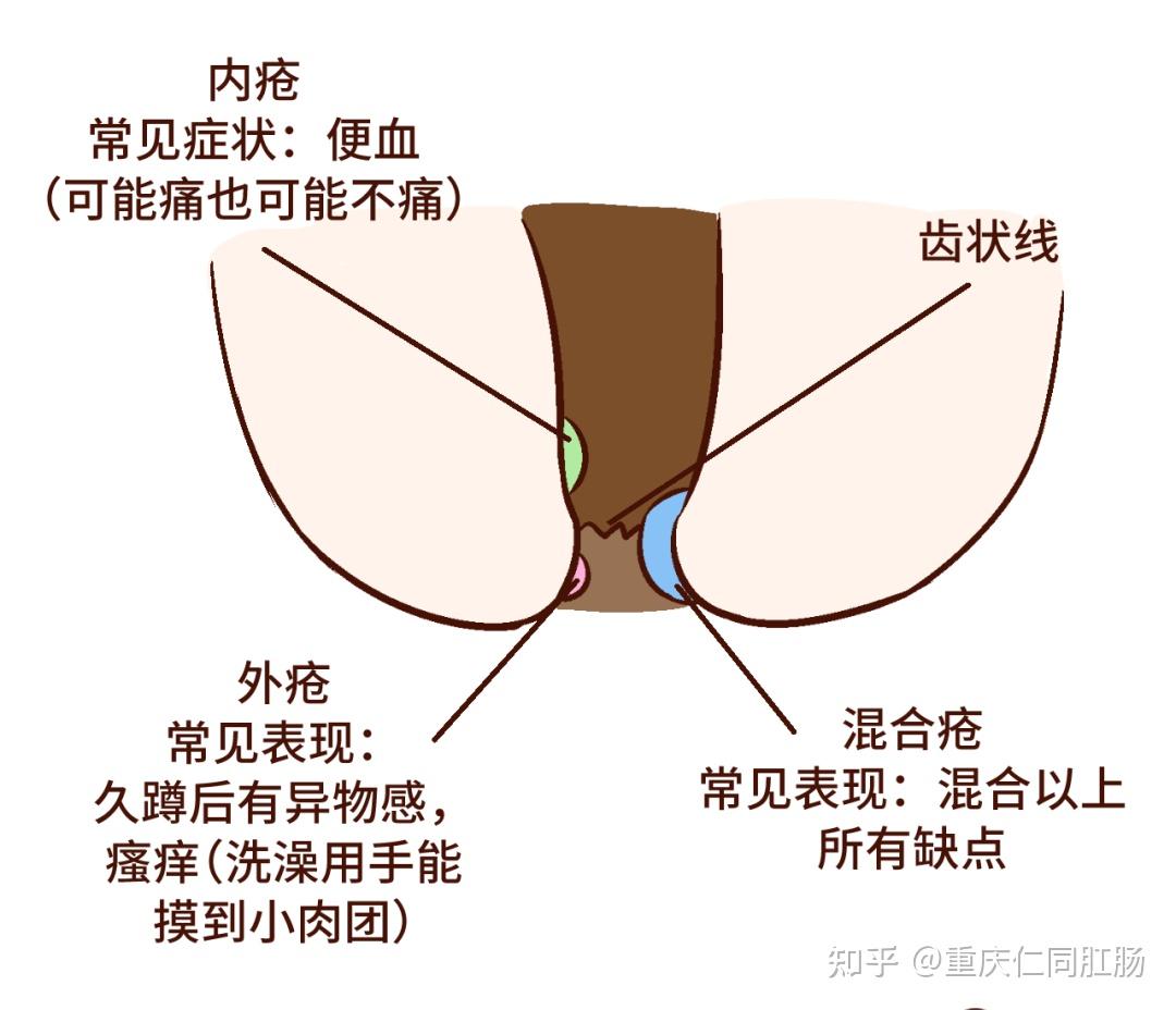 根据发生的痔疮分为内痔,外痔,混合痔;肛门,直肠处的静脉血管丛,淤血