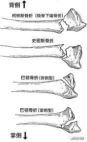 包括向背侧移位的colles骨折,背侧barton骨折;向掌侧移位的smith骨折