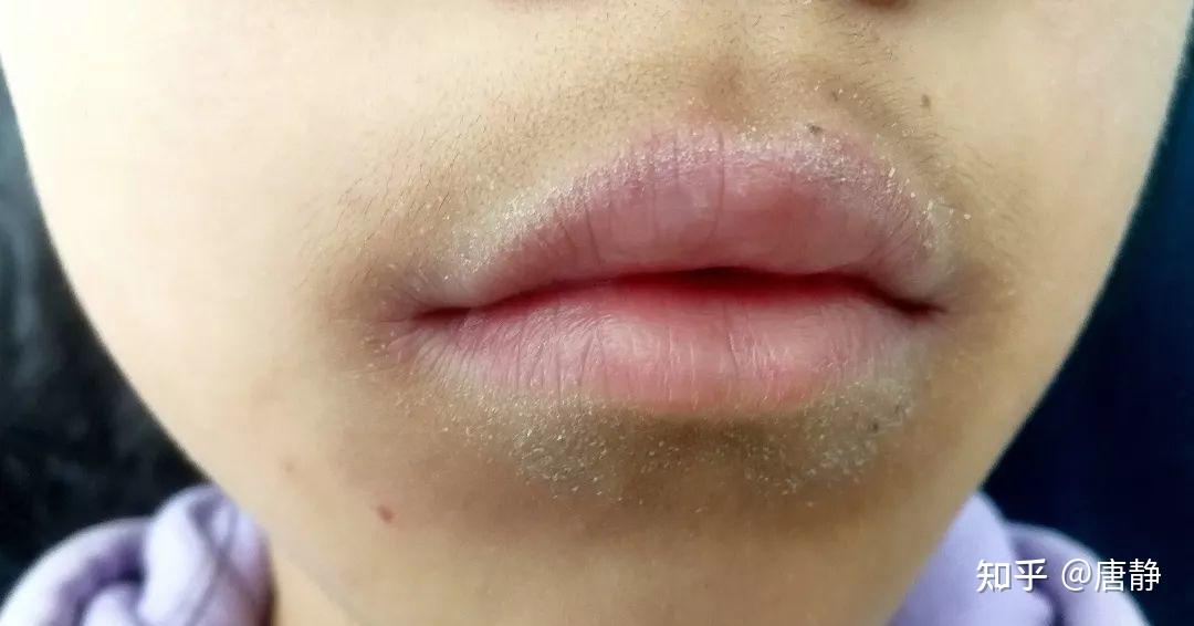 刷牙都“招黑”？这才是脸部美白的老大难！ - 知乎