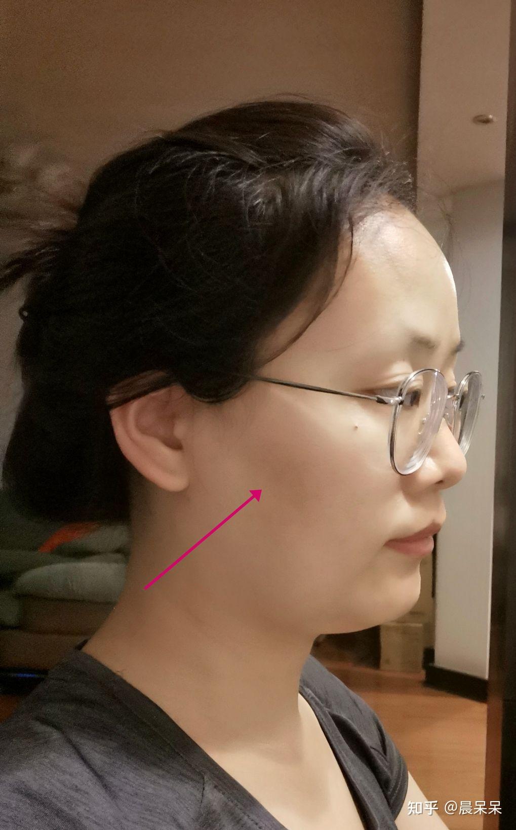 正畸日记骨性嘴凸露龈个别牙缝稀疏26岁开始整牙已矫正2年零9个月