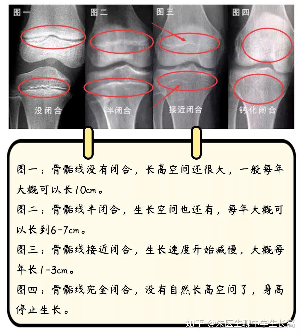 骺板 图解图片