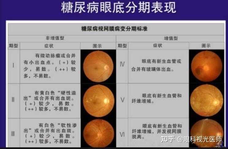 (1)糖尿病性视网膜病变 是糖尿病性微血管病变中最重要的表现,是一种