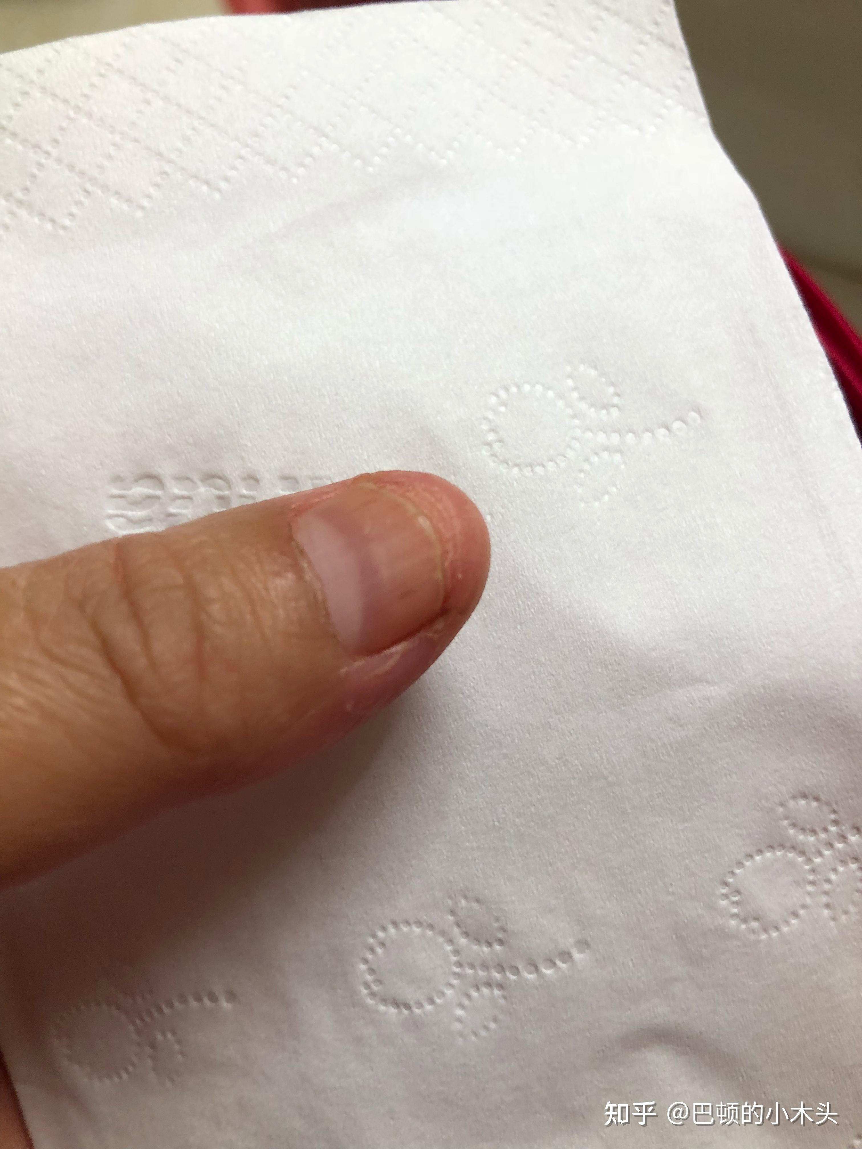 甲分离的宝宝看过来亲身经验希望帮到你们附上照片现在的