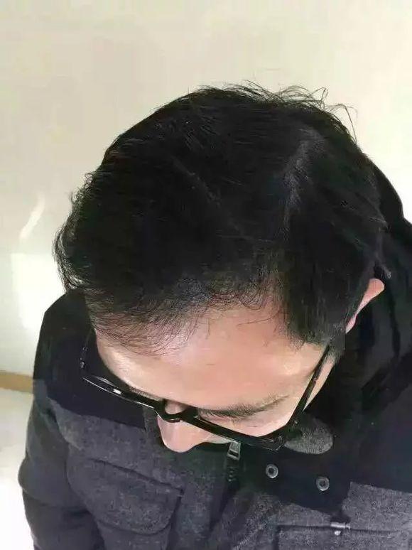 植发的头发永久不脱落吗?为什么有人说植发的