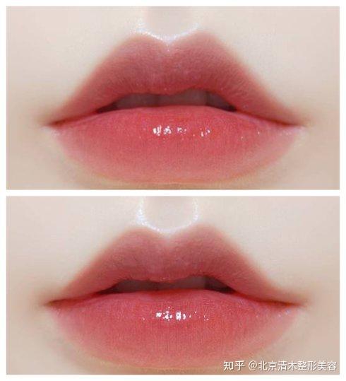 2,有"三珠"上唇有一个唇珠,下唇有两个唇珠,两个唇珠中间会有点凹陷