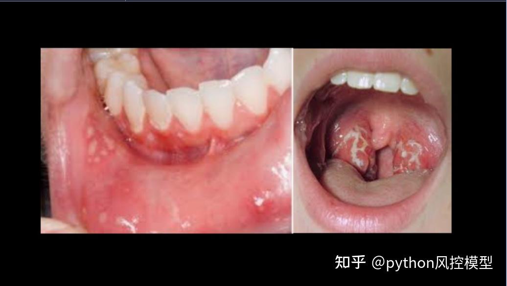 pfapa周期性发热伴口疮性口腔炎咽炎淋巴结炎综合征