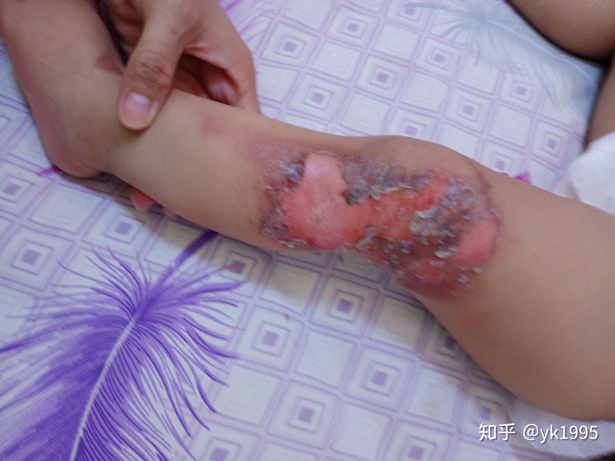 宝宝烫伤第三天,好烦会留疤吗 - 知乎
