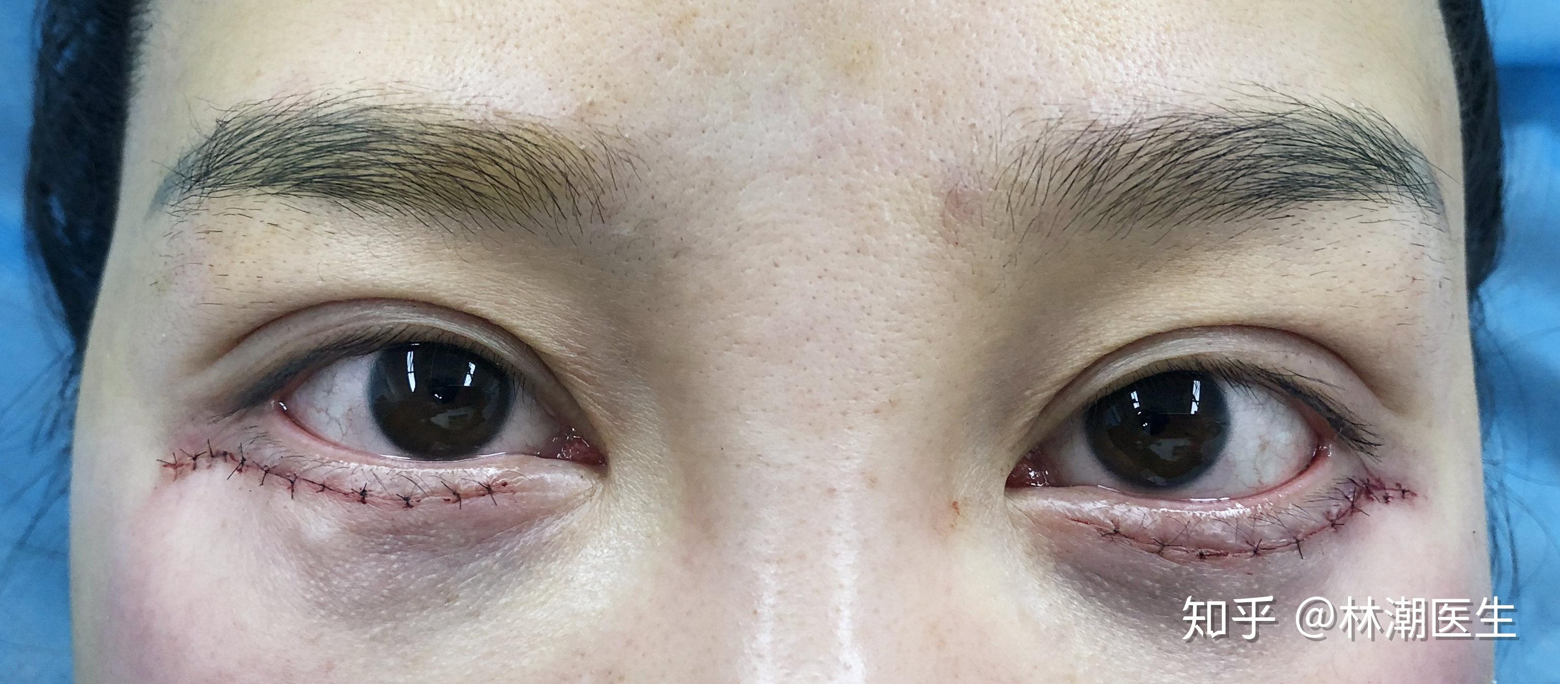 是两个不同的手术,虽然他们的手术切口是一样的,都是经过下睑缘做切口