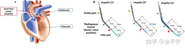 pVAD：心室辅助装置Impella路线的全球领先地位及中国发展前景 - 知乎