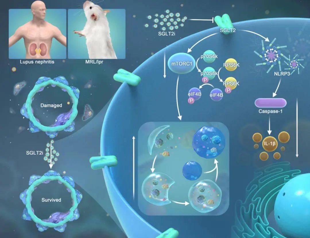 IF 27.4 | 郑大一附院齐媛媛团队发现SGLT2抑制剂通过减少炎症和增强自噬缓解狼疮性肾炎足细胞损伤 - 知乎