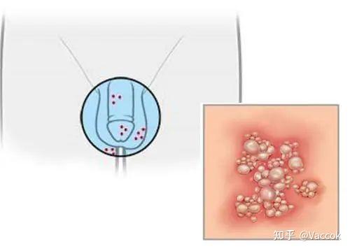 属于性病范畴的有尖锐湿疣,生殖器疱疹,扁平湿疣,念珠菌性龟头包皮炎