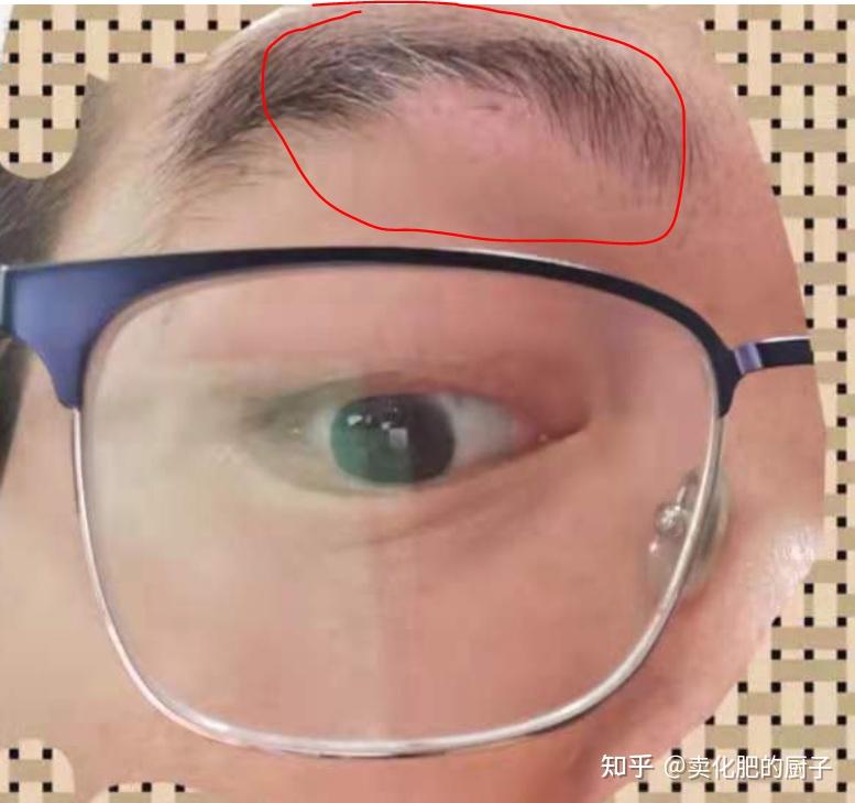 一次晕痣的治疗过程
