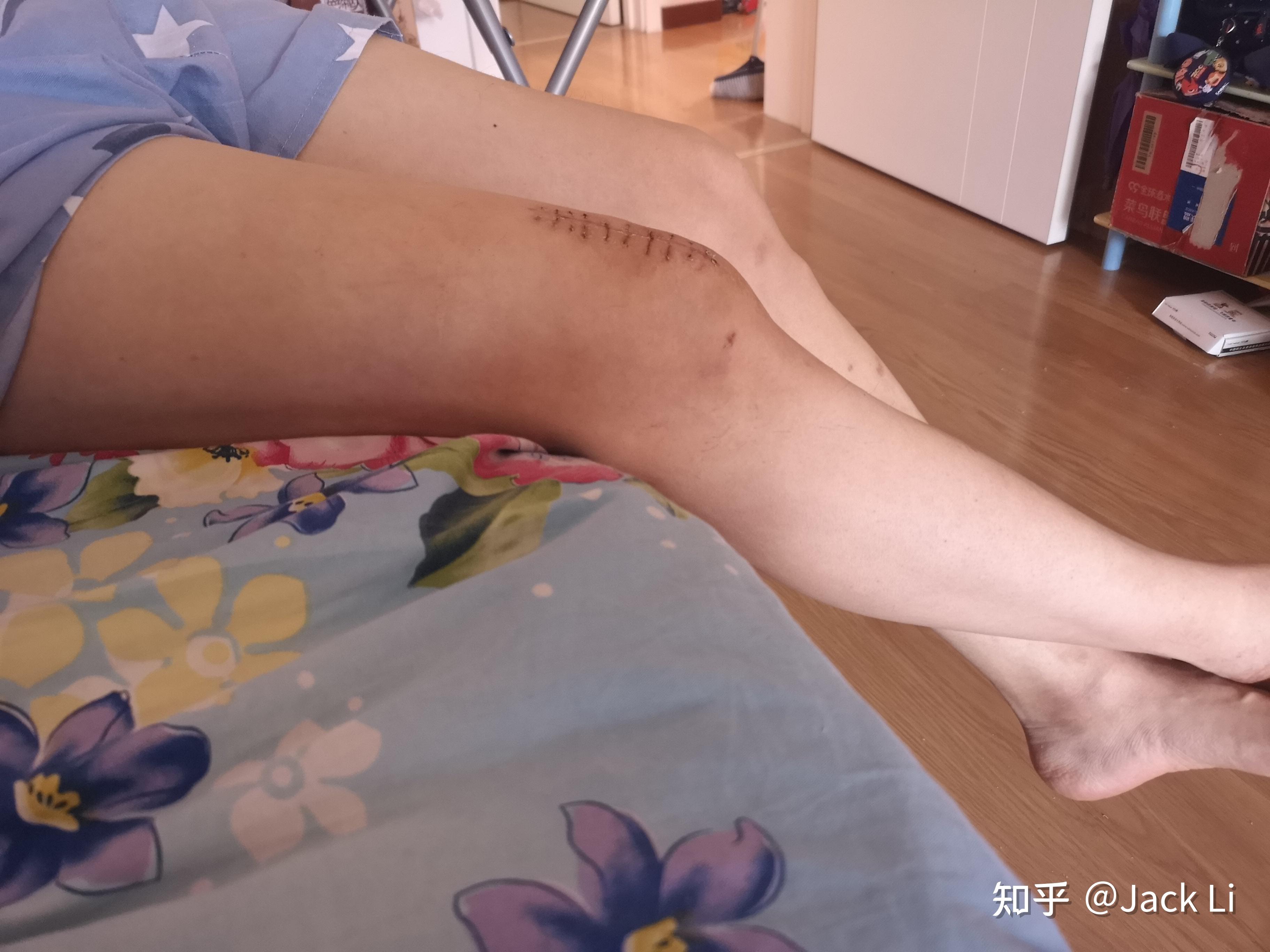 手术方案简单说就是在右腿髌骨上打入两颗特制的金属钉,从大腿肌肉