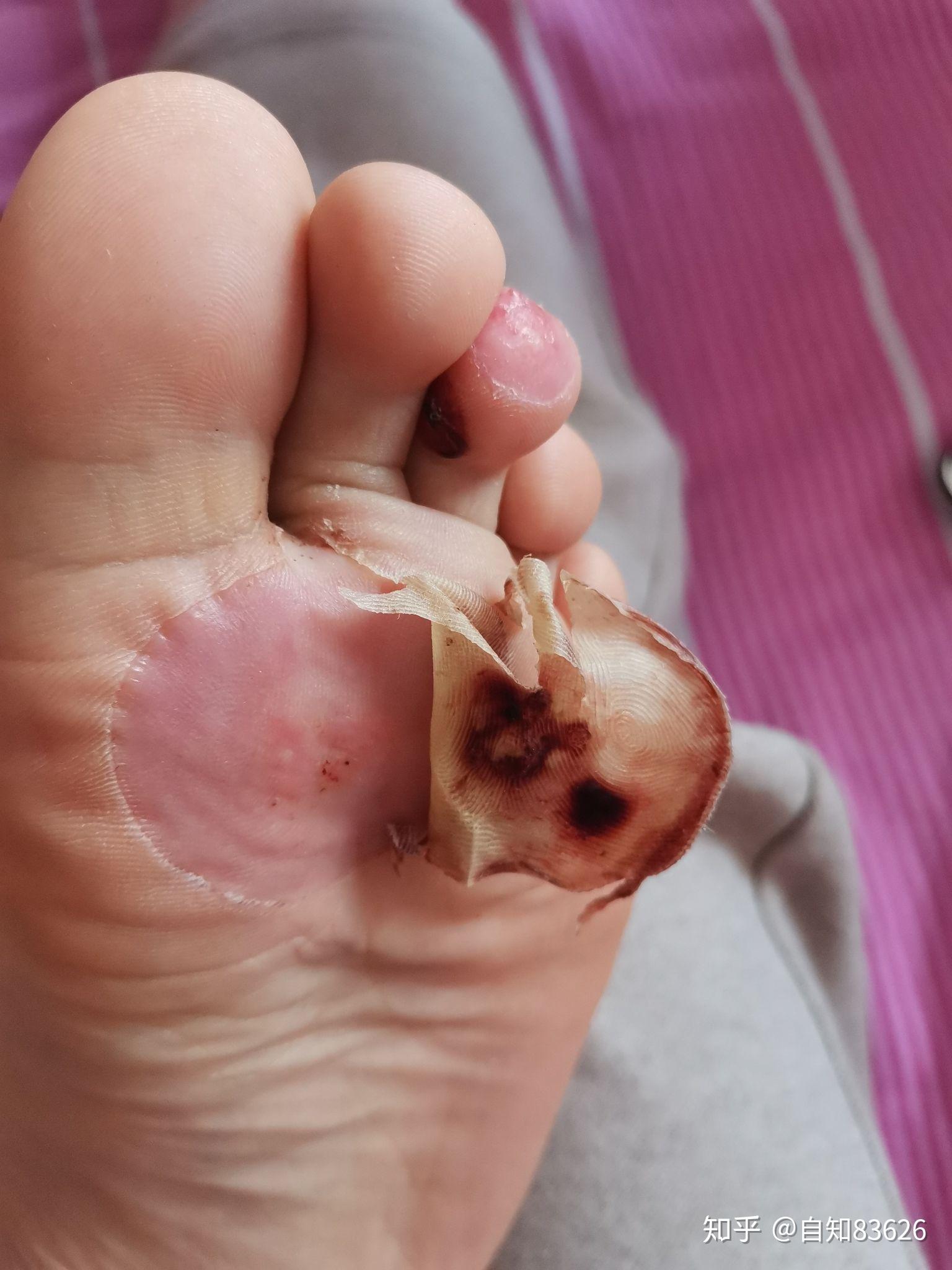 跖疣冷冻后恢复记录