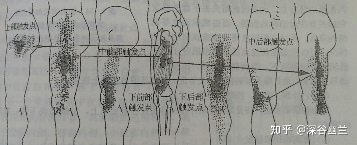 读书笔记——股四头肌触发点