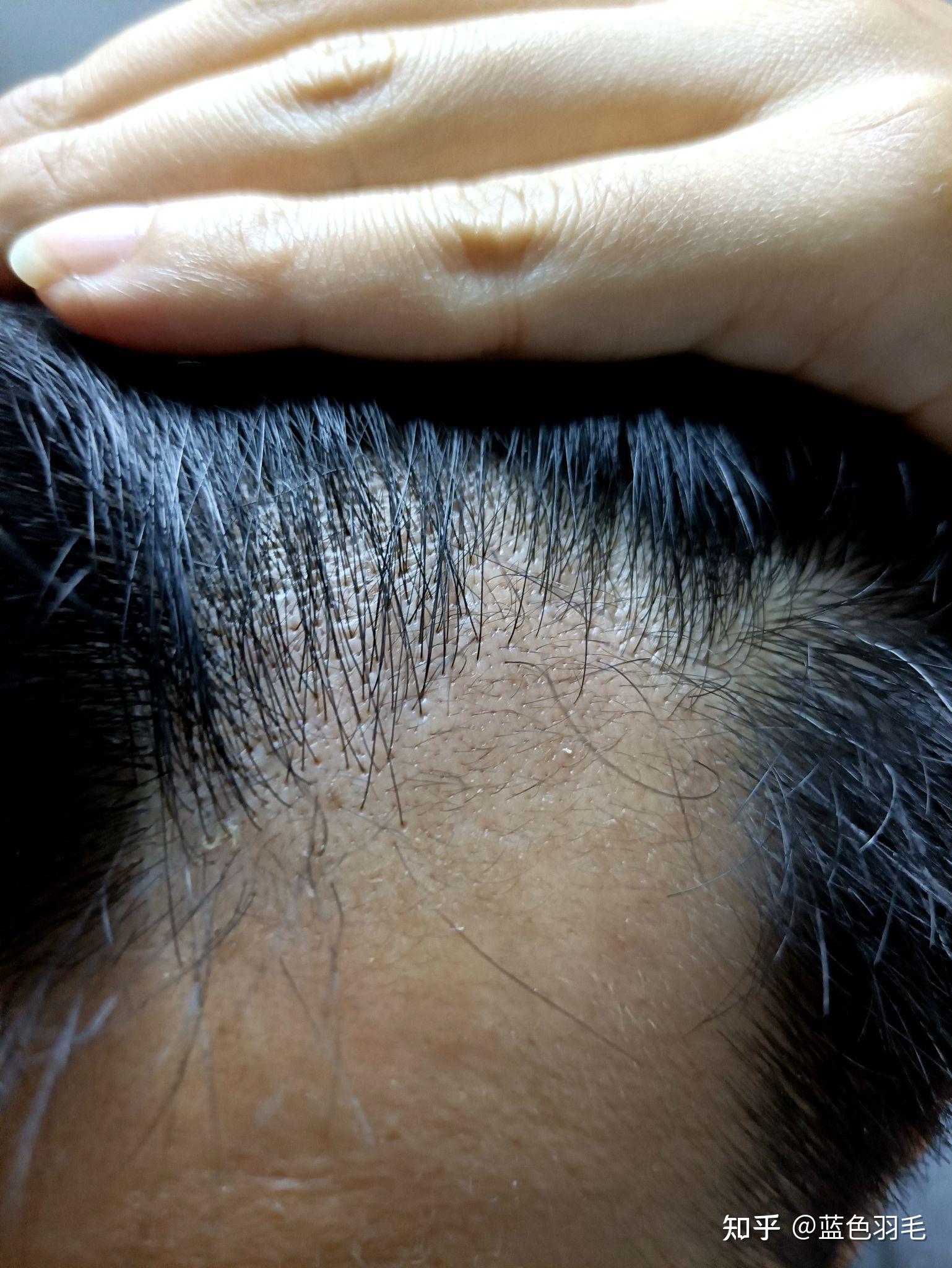 滚轮微针治疗脱发全程记录更新至202256