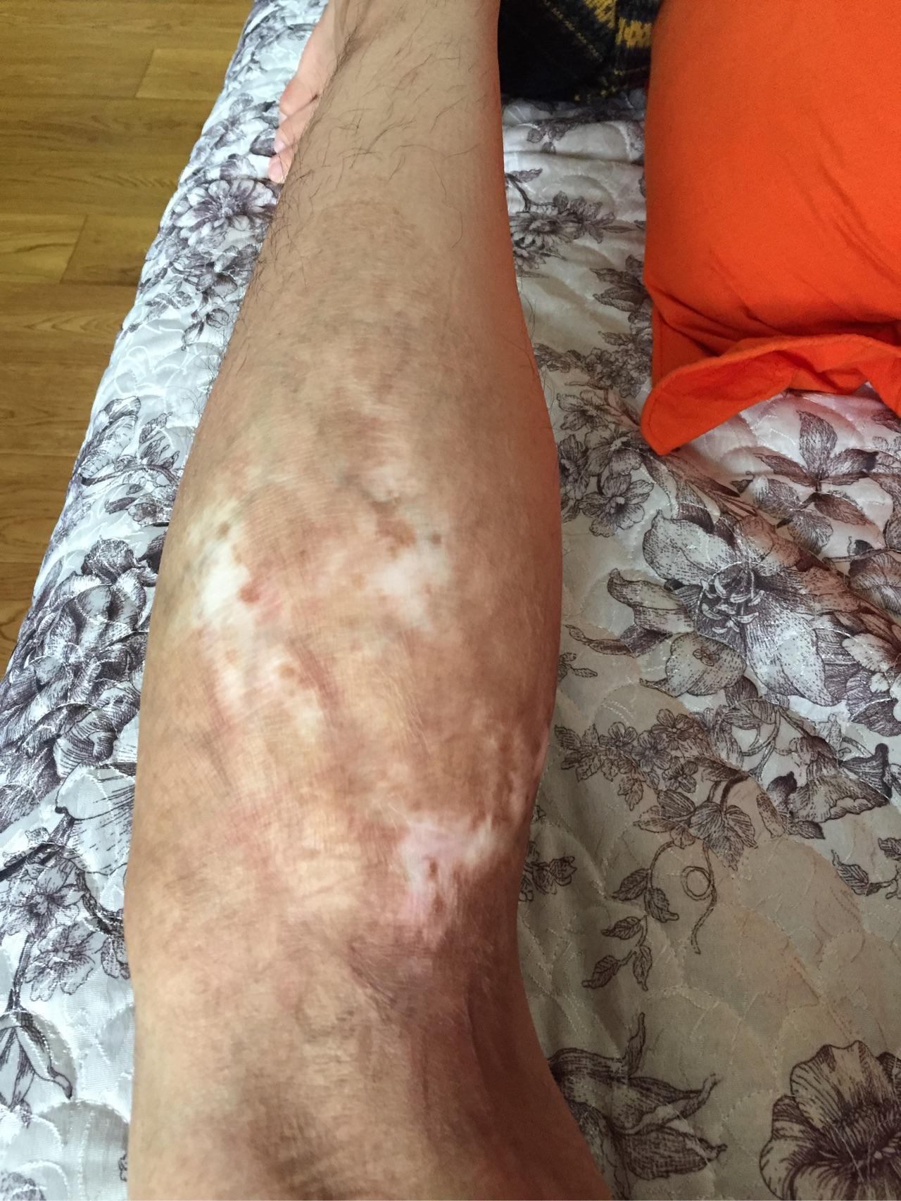 疤痕多久可以完全淡化 v2-c2b48d5f6dc6c39b8a1ab9a7097cadae_r.jpg