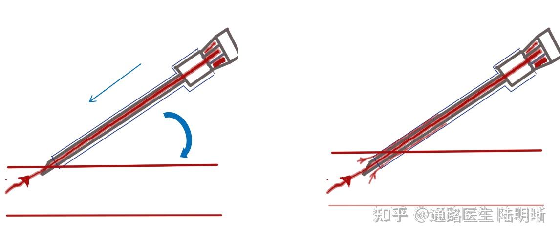 血管旁侧进针示意图图片