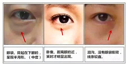 为什么会有眼袋？ - 知乎