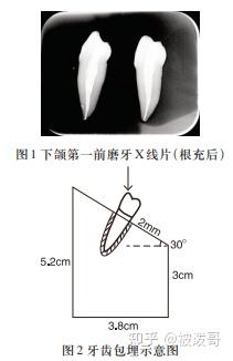 冠折年轻恒牙根管治疗后不同修复方法的抗折强度研究 - 知乎