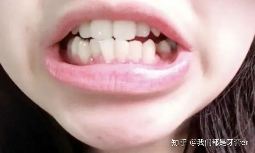 16年2月份去的口腔医院,因为龅牙的原因,所以拔了4颗4号牙,让牙齿内收