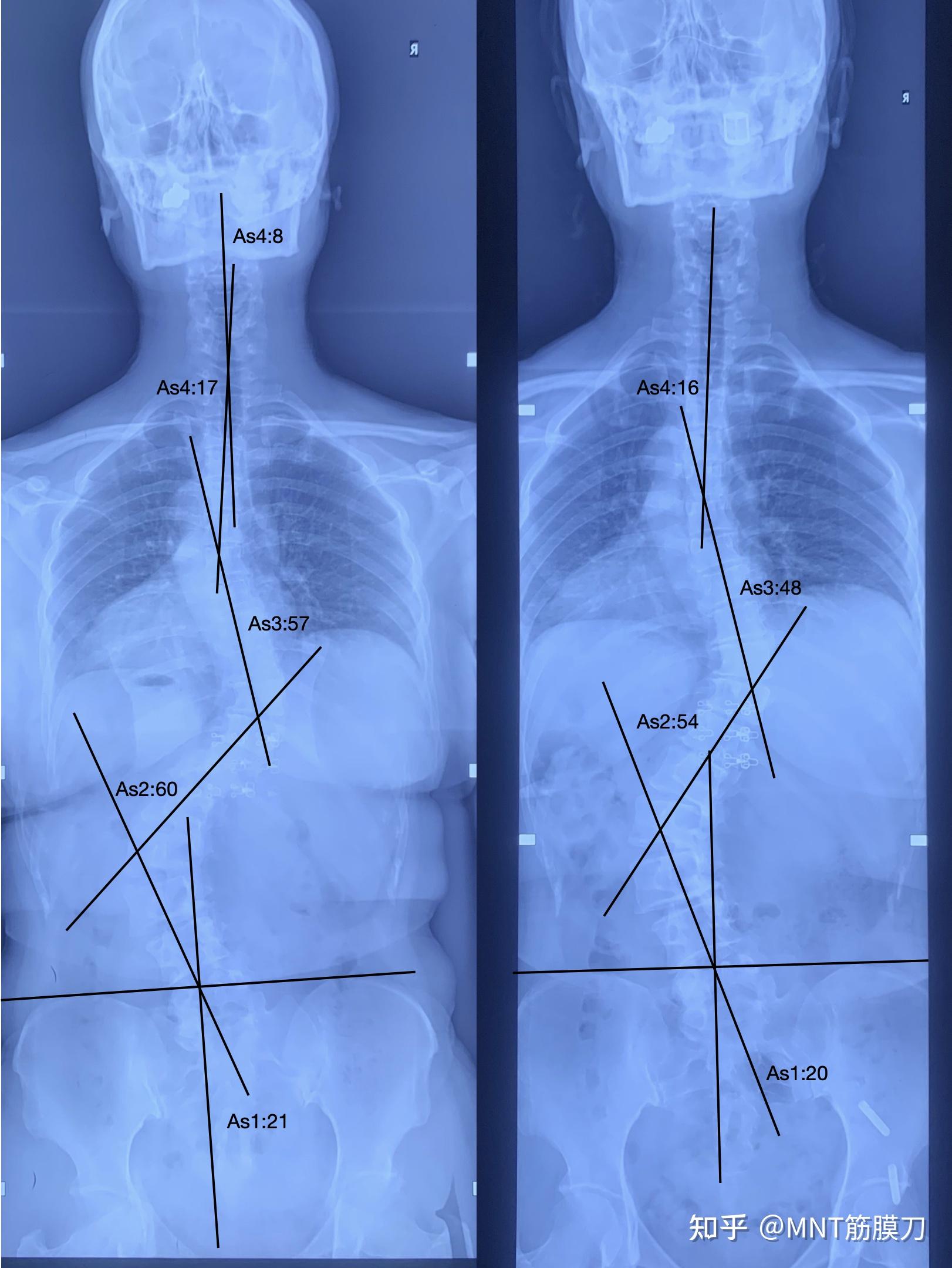 胸椎向右侧弯图片