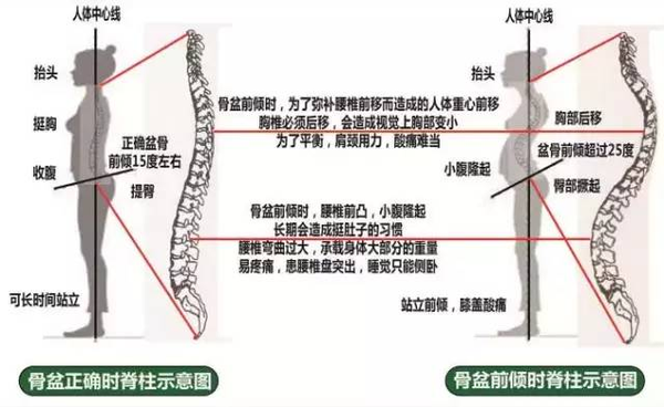 骨盆前倾和后倾傻傻分不清 一文搞懂这俩体态问题的异同 知乎 骨盆前倾和后倾傻傻分不清 一文搞懂这俩体态问题的异同 知乎