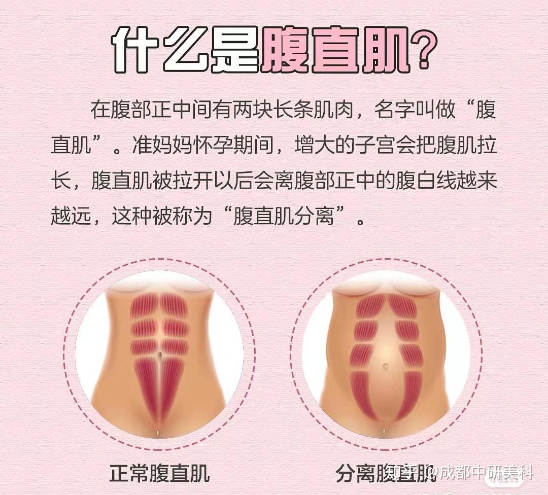 腹直肌分离有哪些信号